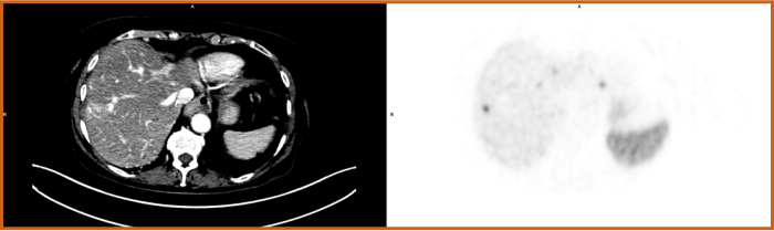 Copper Cu 64 dotatate scan 1 year after radioligand therapy showing partial response to therapy.