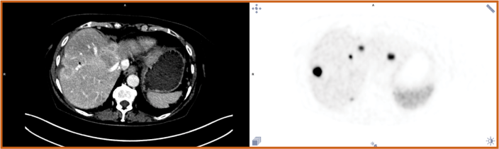 Copper Cu 64 dotatate scan before radioligand therapy.