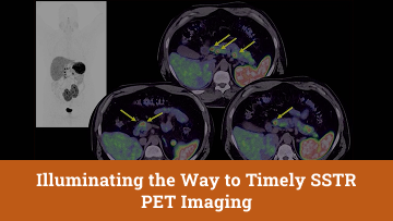Video about high-accuracy imaging and timely SSTR PET imaging.